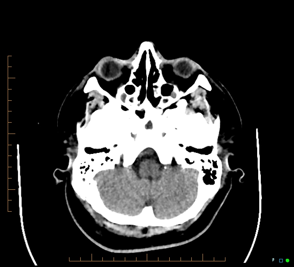 Cerebral fat embolism (Radiopaedia 85521-101220 Axial non-contrast 17).jpg