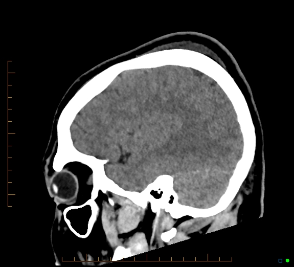 Cerebral fat embolism (Radiopaedia 85521-101224 C 14).jpg