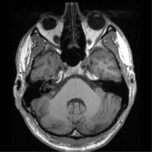 File:Cerebral hemorrhagic contusions- temporal evolution (Radiopaedia 40224-42757 Axial T1 20).png
