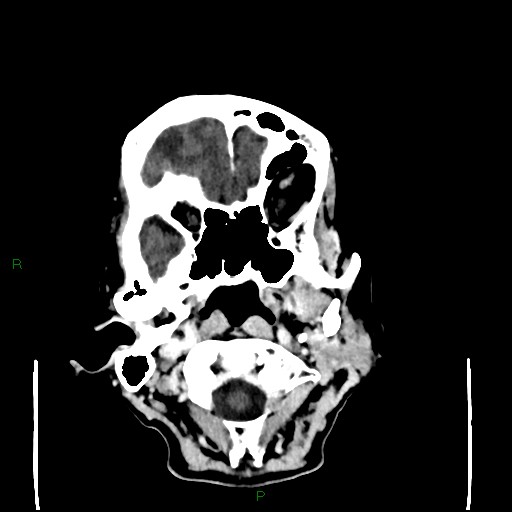Cerebral metastases - breast primary (Radiopaedia 77653-89857 Axial C+ delayed 17).jpg