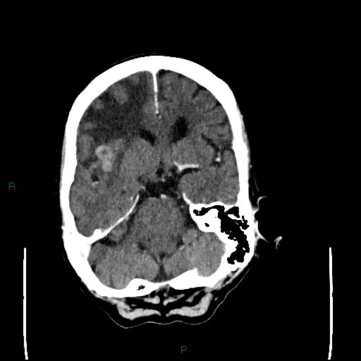 File:Cerebral metastases - breast primary (Radiopaedia 77653-89857 Axial C+ delayed 41).jpg