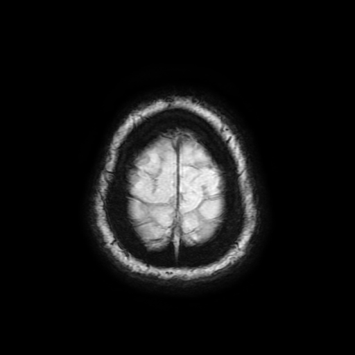 Cerebral metastases - melanoma (Radiopaedia 80972-94522 Axial SWI 92).jpg