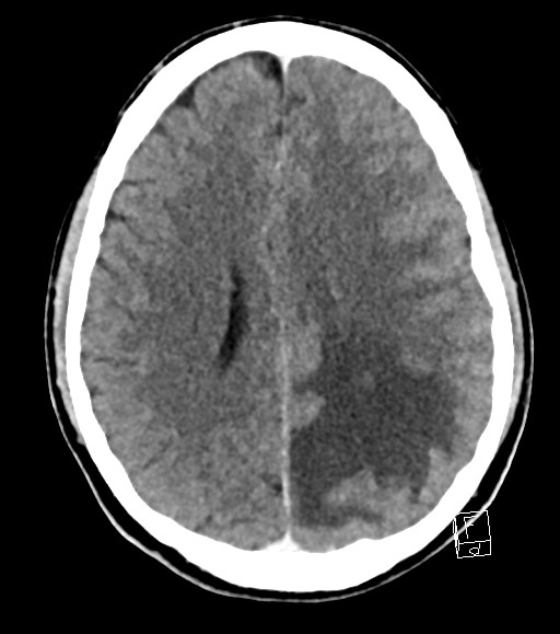 Cerebral metastases - testicular choriocarcinoma (Radiopaedia 84486-99855 Axial C+ delayed 23).jpg