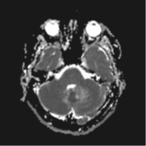 File:Cerebral metastases mimicking abscesses (Radiopaedia 45841-50131 Axial ADC 9).png