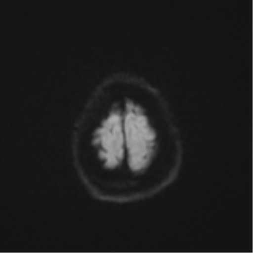 File:Cerebral metastasis (Radiopaedia 46744-51248 Axial DWI 54).png