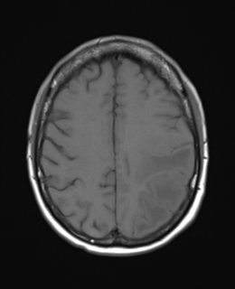 File:Cerebral metastasis (Radiopaedia 46744-51248 Axial T1 20).png