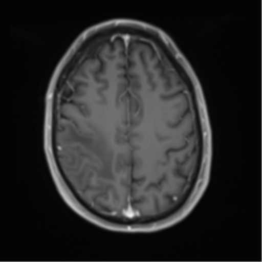 File:Cerebral metastasis - melanoma (Radiopaedia 54718-60954 Axial T1 C+ fat sat 40).png