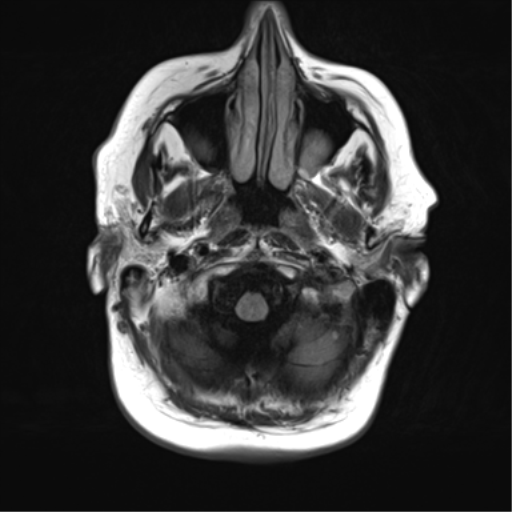 File:Cerebral metastasis mimicking glioblastoma (Radiopaedia 69155-78937 Axial FLAIR 5).png