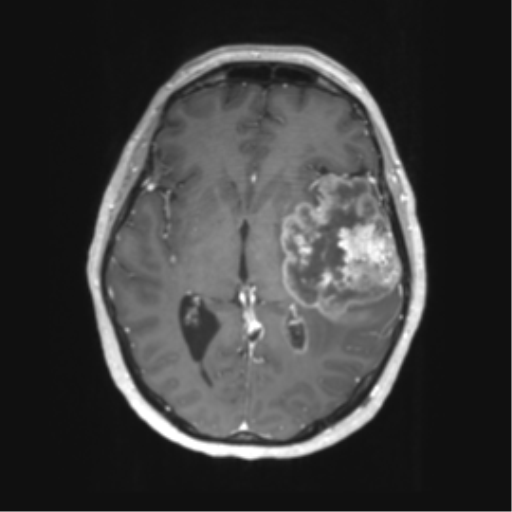 File:Cerebral metastasis mimicking glioblastoma (Radiopaedia 69155-78937 Axial T1 C+ 31).png