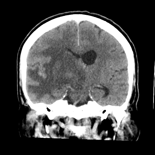 Cerebral metastasis to basal ganglia (Radiopaedia 81568-95412 Coronal C+ delayed 33).png