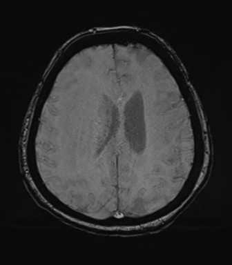 Cerebral metastasis to basal ganglia (Radiopaedia 81568-95413 Axial SWI 60).png