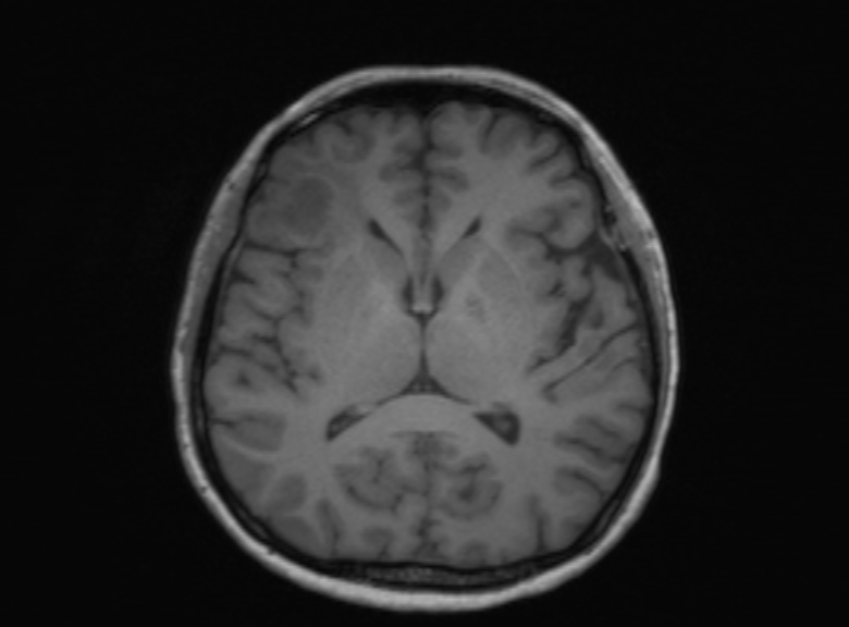 Cerebral ring enhancing lesions - cerebral metastases (Radiopaedia 44922-48817 Axial T1 220).jpg