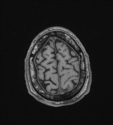 File:Cerebral toxoplasmosis (Radiopaedia 43956-47461 Axial T1 70).jpg