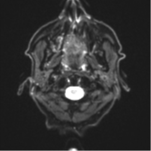 Cerebral toxoplasmosis (Radiopaedia 54575-60804 Axial DWI 3).png