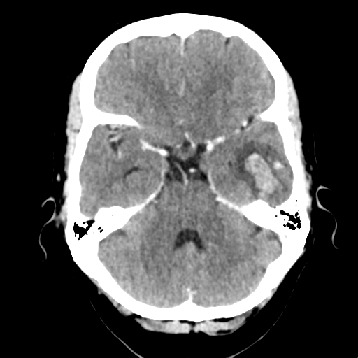 File:Cerebral venous hemorrhagic infarction (Radiopaedia 57576-64538 Axial C+ 14).png