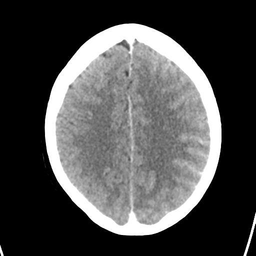 Cerebral venous hemorrhagic infarction (Radiopaedia 57576-64538 Axial C+ 33).png