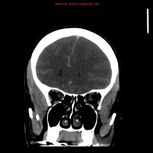 Cerebral venous infarction (Radiopaedia 12404-20735 B 22).jpg
