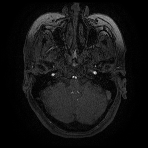 Cerebral venous infarction (Radiopaedia 25109-25363 MRA 35).jpg