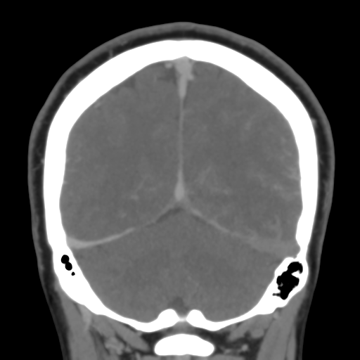 File:Cerebral venous infarction due to transverse sinus thrombosis (Radiopaedia 34688-36120 Coronal 46).png