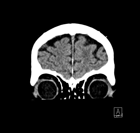 Cerebral venous infarction with hemorrhage (Radiopaedia 65343-74381 Coronal non-contrast 5).jpg