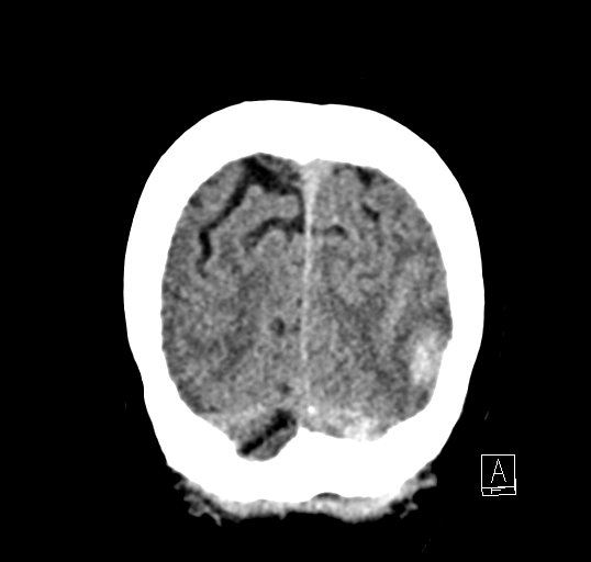 Cerebral venous infarction with hemorrhage (Radiopaedia 65343-74381 Coronal non-contrast 51).jpg