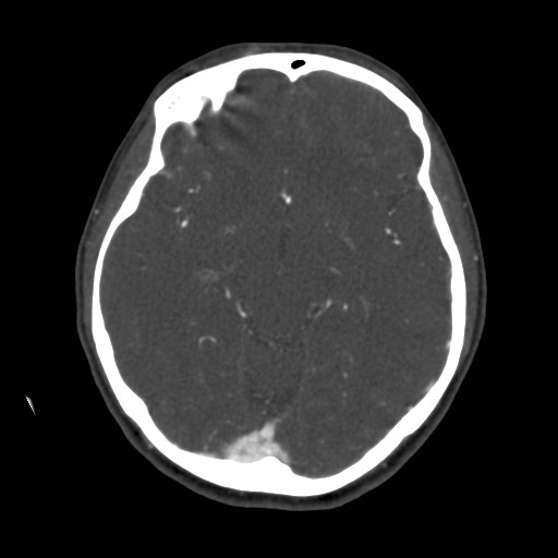 Cerebral venous sinus thrombosis (Radiopaedia 40619-43227 A 98).jpg