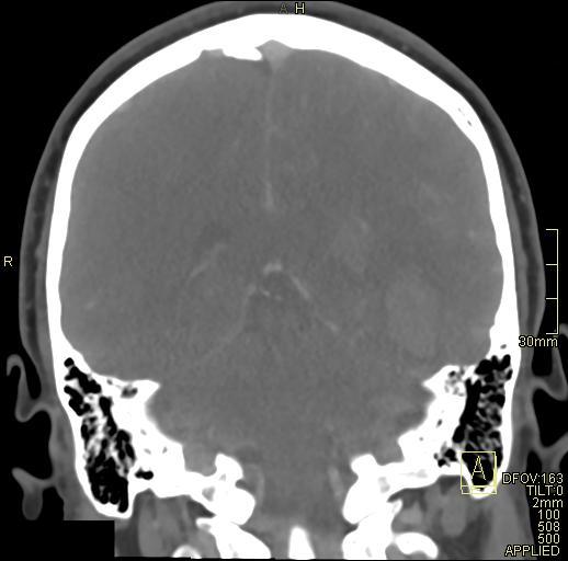 Cerebral venous sinus thrombosis (Radiopaedia 91329-108965 Coronal venogram 58).jpg