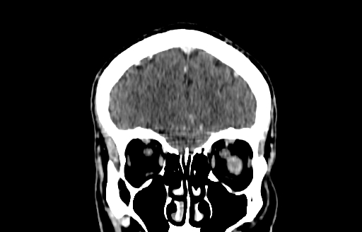 File:Cerebral venous thrombosis (CVT) (Radiopaedia 77524-89685 C 10).jpg