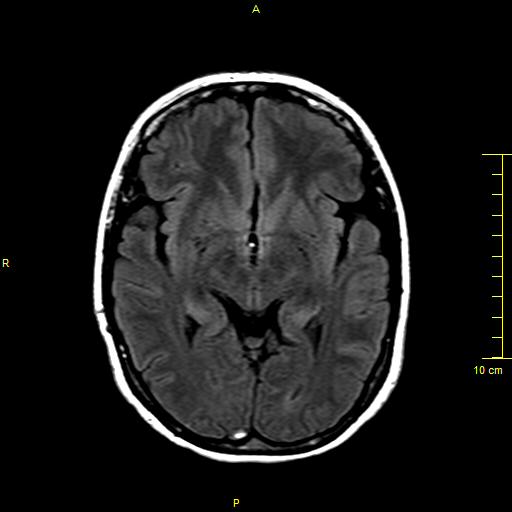 File:Cerebral venous thrombosis (Radiopaedia 23288-23351 Axial FLAIR 8).JPG