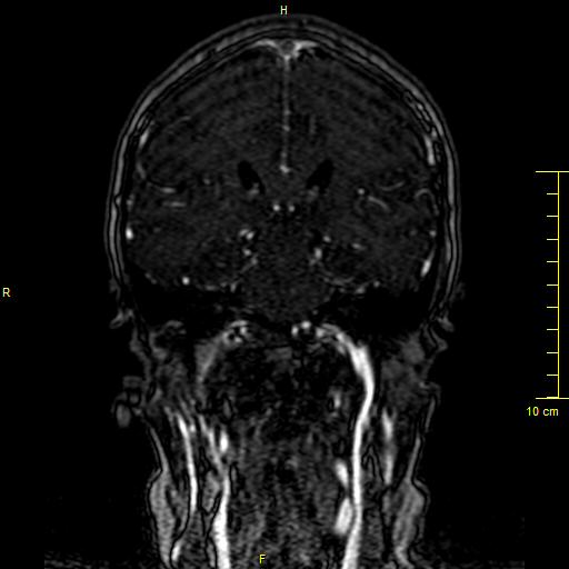 Cerebral venous thrombosis (Radiopaedia 23288-23351 MRV 91).JPG