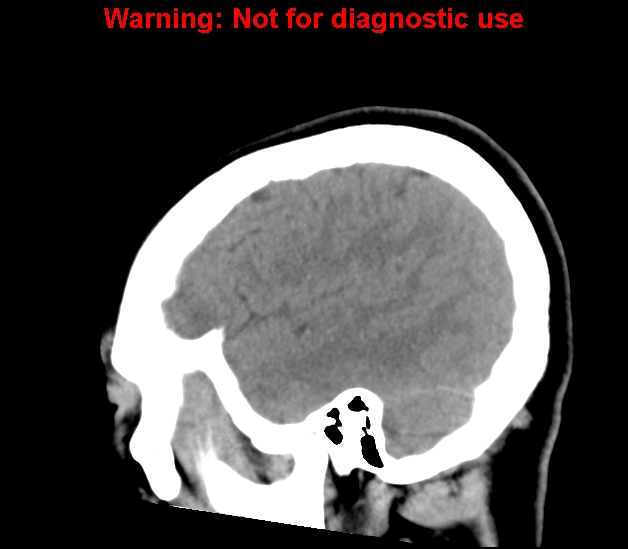 File:Cerebral venous thrombosis (Radiopaedia 37224-38992 B 7).jpg