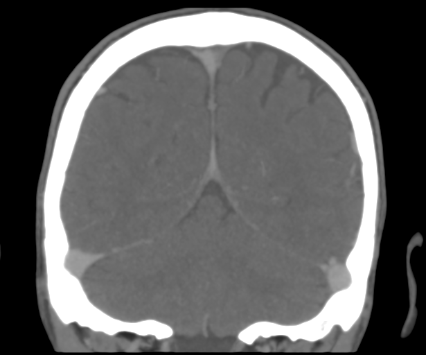 Cerebral venous thrombosis (Radiopaedia 38392-40467 Coronal CTA-Venogram 47).png