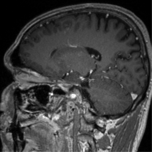 File:Cerebral venous thrombosis (Radiopaedia 38392-40469 Sagittal T1 C+ 37).png