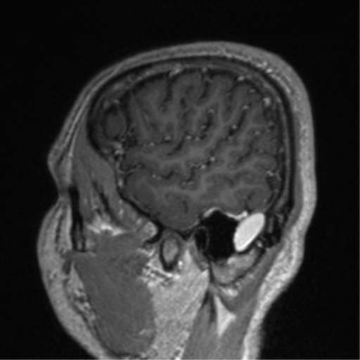 File:Cerebral venous thrombosis (Radiopaedia 38392-40469 Sagittal T1 C+ 74).png