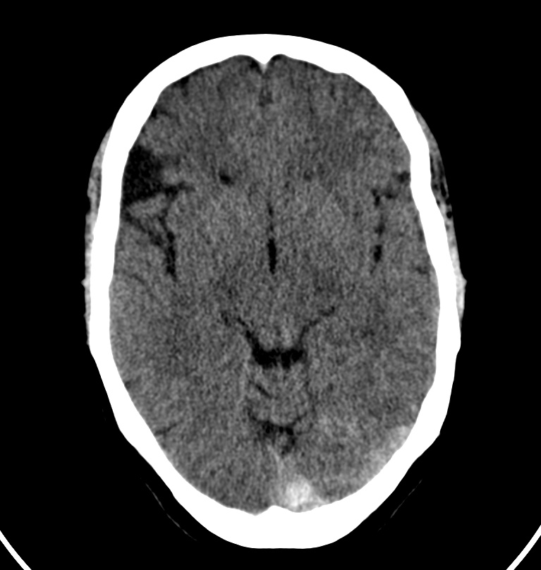 Cerebral venous thrombosis - CT only (Radiopaedia 41031-43778 Axial non-contrast 49).jpg