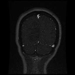 Cerebral venous thrombosis - ulcerative colitis (Radiopaedia 66049-75219 Coronal MRV 22).jpg