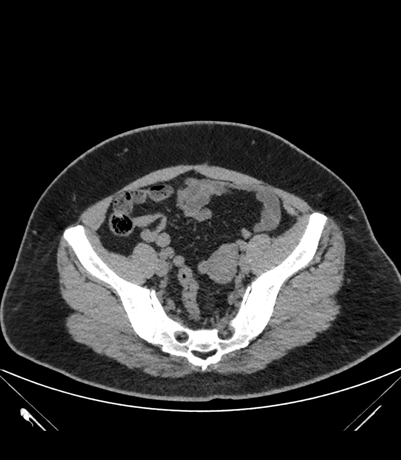 Cervical aortic arch with coarctation and aneurysms (Radiopaedia 44035-47552 Axial non-contrast 83).jpg