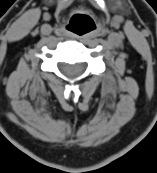 File:Cervical canal stenosis - OPLL and osteophytes (Radiopaedia 47329-51910 Axial non-contrast 29).png
