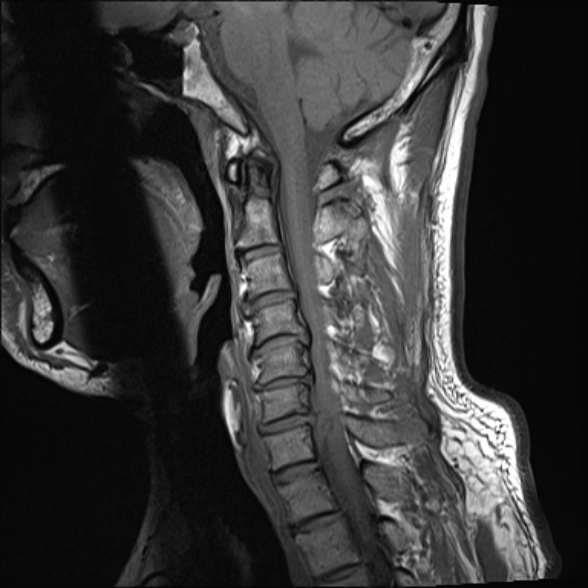File:Cervical disc extrusion (Radiopaedia 53950-60077 Sagittal T1 10).jpg