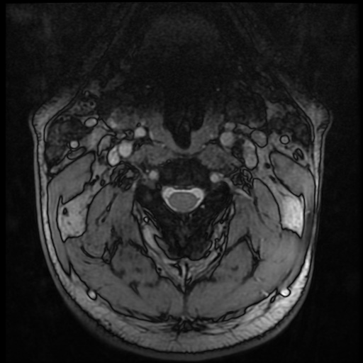 Cervical disc extrusion (Radiopaedia 59074-66364 G 12).jpg