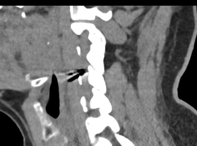 File:Cervical disc replacement (Radiopaedia 44025-47541 B 39).png