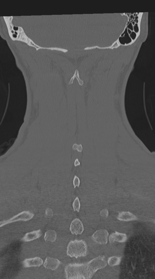 Cervical intercalary bone (Radiopaedia 35211-36748 Coronal bone window 63).png