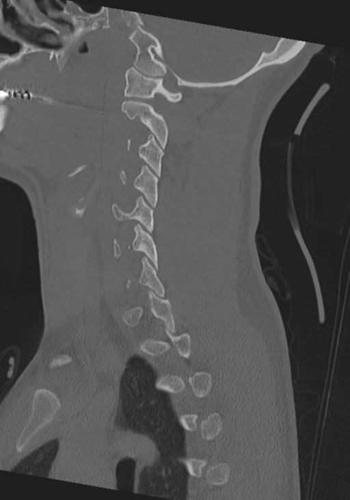 Cervical intercalary bone (Radiopaedia 35211-36748 Sagittal bone window 53).png