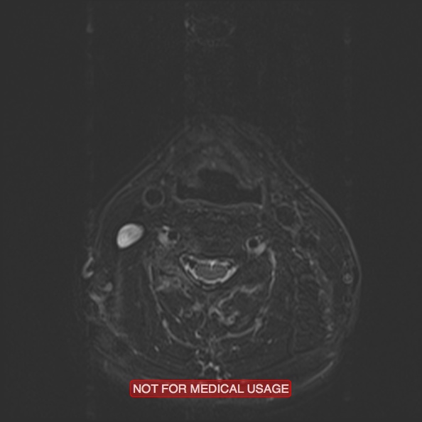 File:Cervical nerve schwannoma (Radiopaedia 27964-28221 C 34).jpg