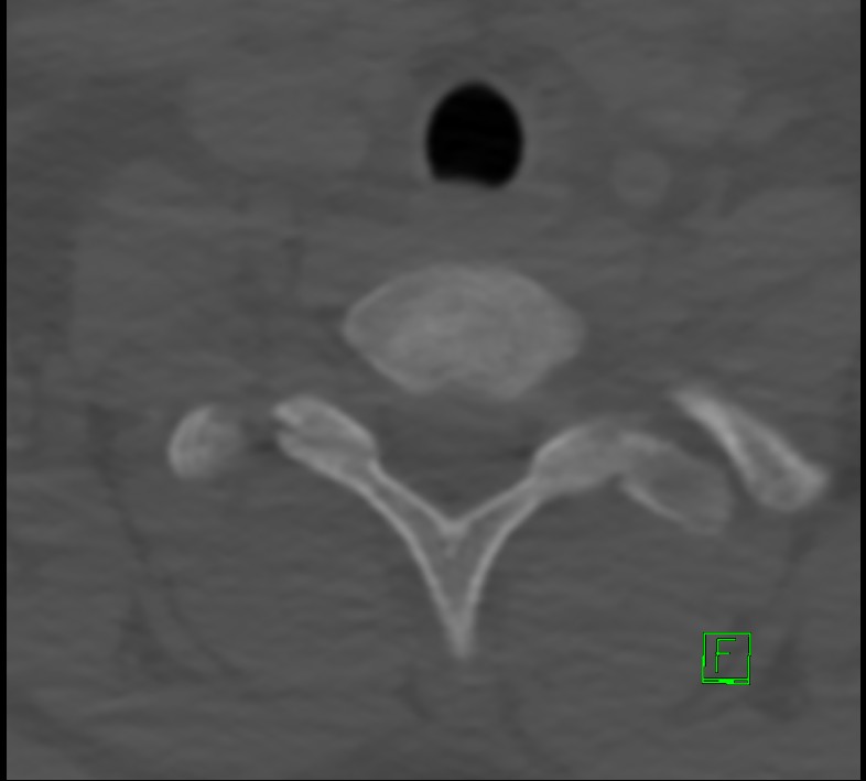Cervical spine fracture - hyperflexion injury (Radiopaedia 66184-75364 Axial bone window 50).jpg