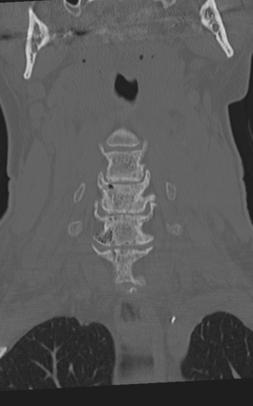 Cervical spine fractures with vertebral artery dissection (Radiopaedia 53296-59268 Coronal bone window 19).png