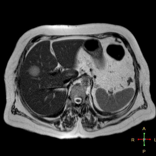 File:Cervical stump squamous cell carcinoma (Radiopaedia 48049-52858 I 11).jpg