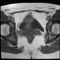 File:Cesarean scar ectopic pregnancy (Radiopaedia 77286-89362 Axial T1 18).jpg