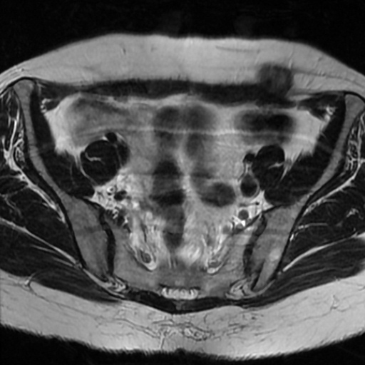 File:Cesarian section scar endometriosis (Radiopaedia 66520-75799 Axial T2 5).jpg