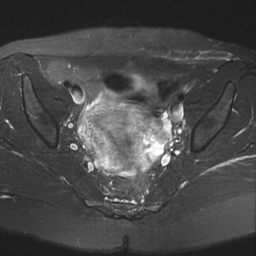 File:Cesarian section scar endometriosis (Radiopaedia 66520-75799 Axial T2 fat sat 11).jpg